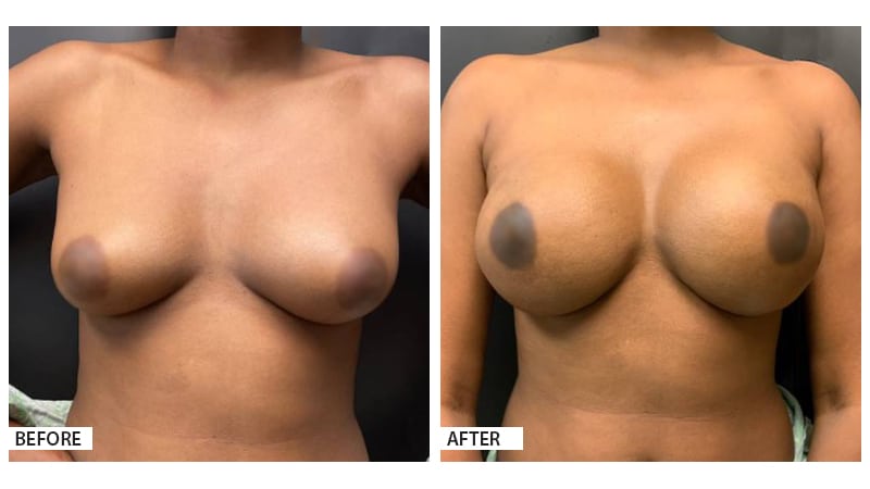 Breast Reconstruction