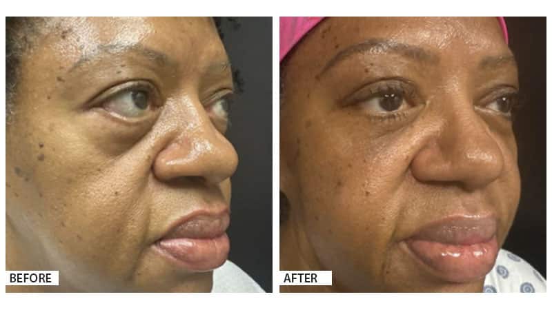 Blepharoplasty, Plastic Surgery