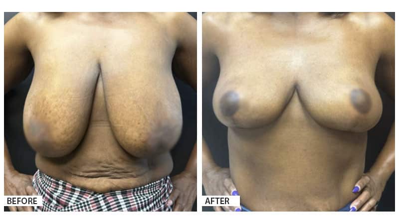 Breast Reduction/Lift