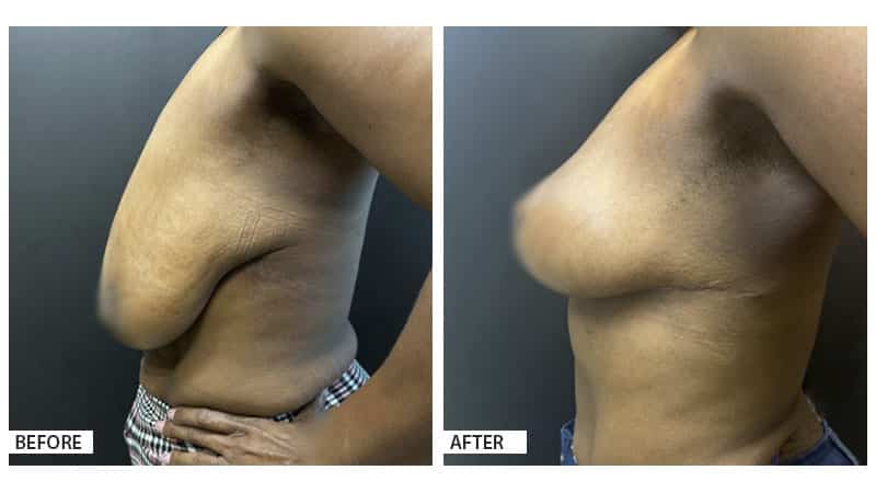 Breast lift, breast reduction, plastic surgery