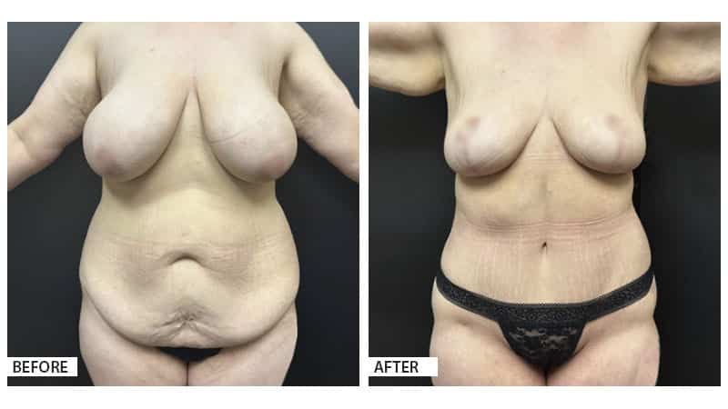 mommy makeover, breast lift, tummy tuck, plastic surgery