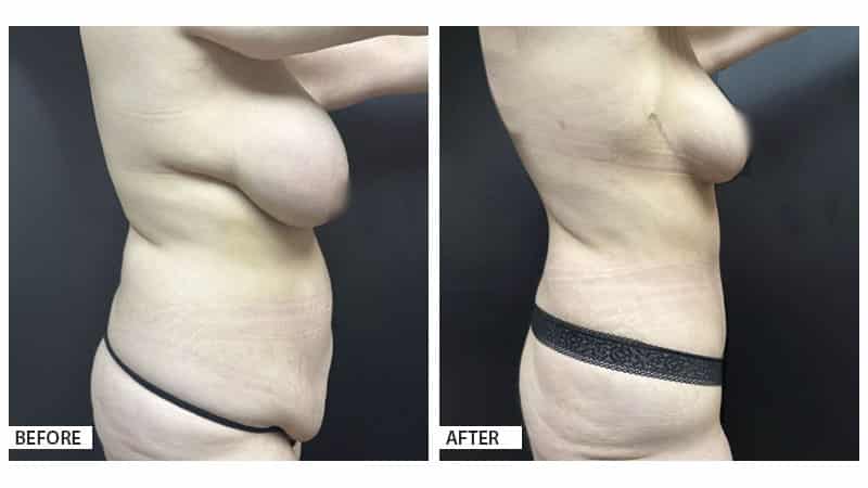 mommy makeover, breast lift, tummy tuck, plastic surgery