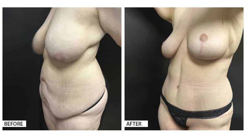 mommy makeover, breast lift, tummy tuck, plastic surgery